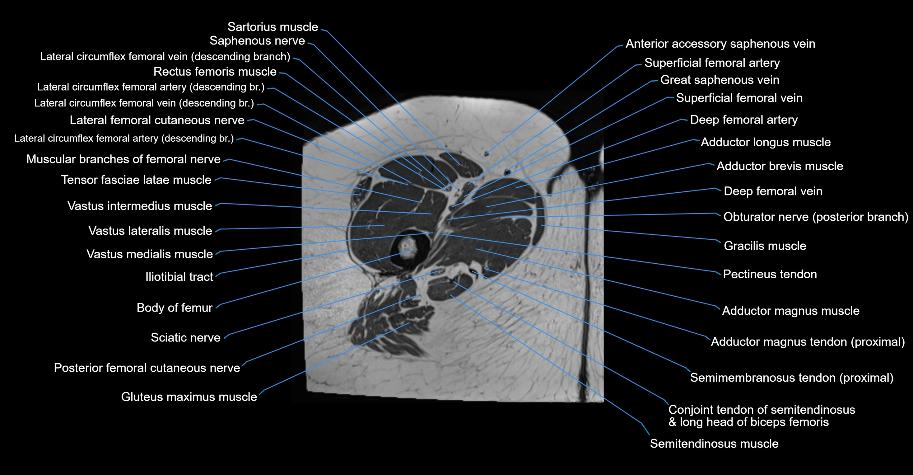 MRI hip axial cross sectional anatomy 3T 3D  radiology  anatomy image-img-00001-00088.webp